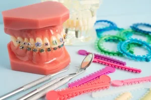 Mengenal Berbagai Jenis Behel Gigi untuk Mendapatakan Kenyamanan dan Estetika